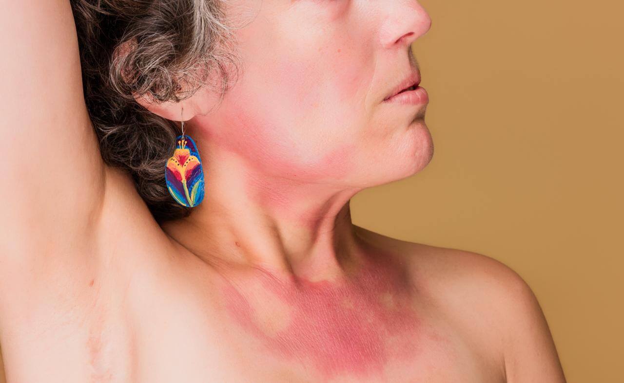 Woman experiencing hives and red skin reactions during menopause after 40.
