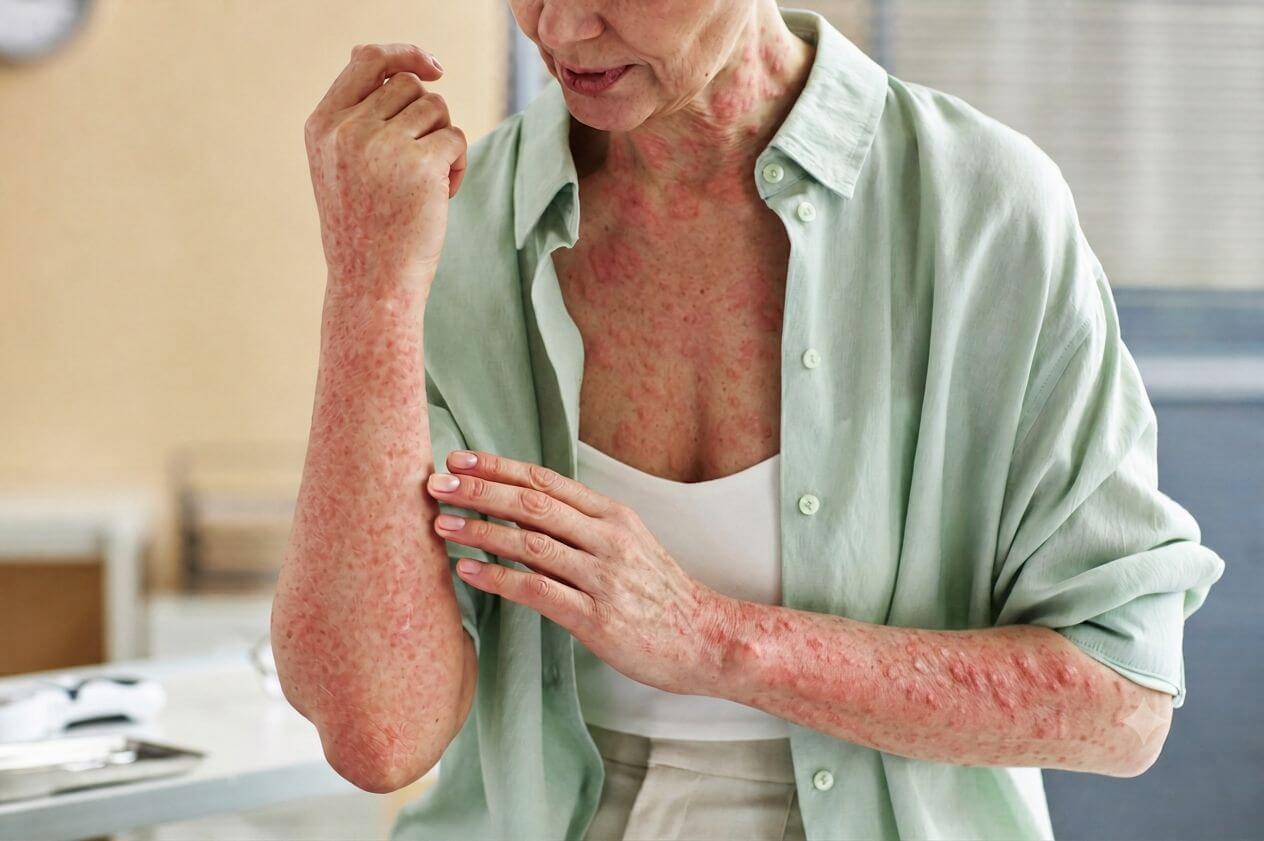 Woman with widespread itchy skin rash and hives seeking medical attention