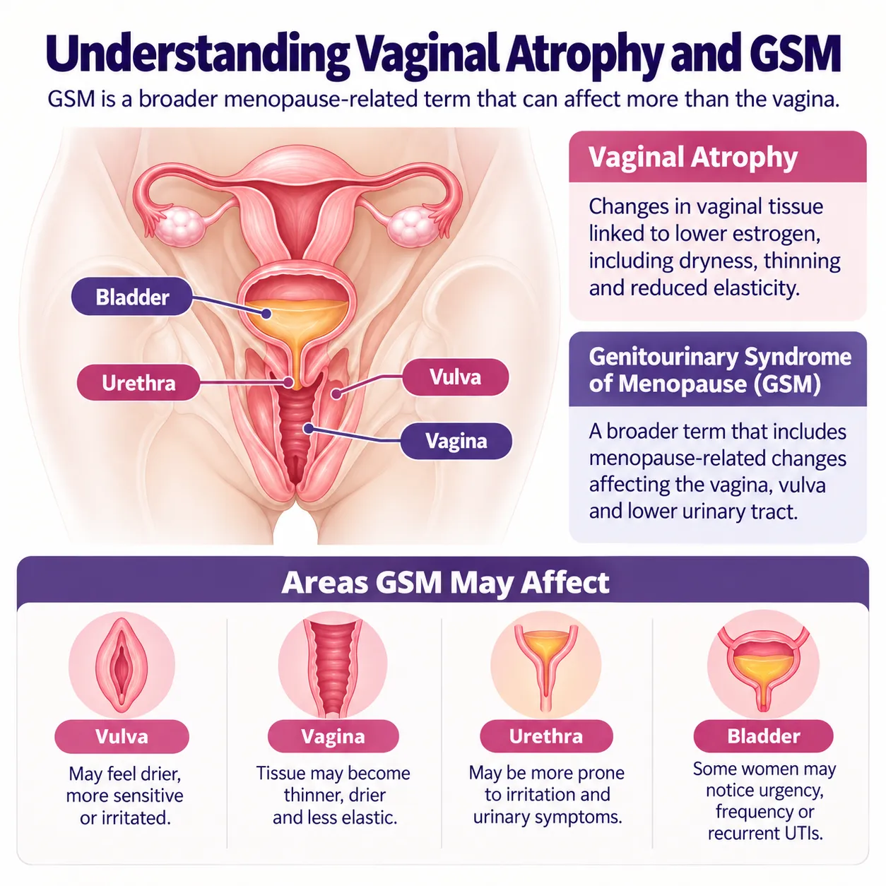 Medical illustration of vaginal atrophy and genitourinary syndrome of menopause (GSM), showing the vagina, vulva, urethra and bladder.